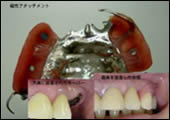 磁性アタッチメントを用いた金属床義歯。