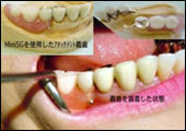 Mini SGを用いたアタッチメント義歯。